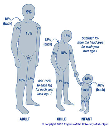 Calculate body surface area burned Calculate body surface area burned image